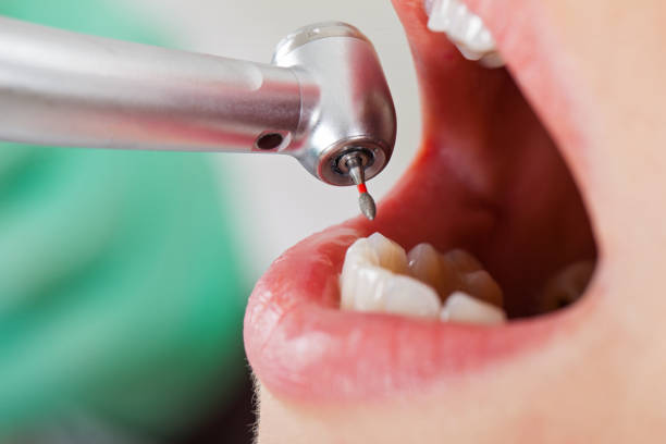 Best Emergency Dental Extractions in Waretown, NJ
